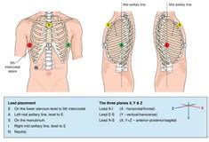 Image result for Synchronized Cardioversion Lead Placement