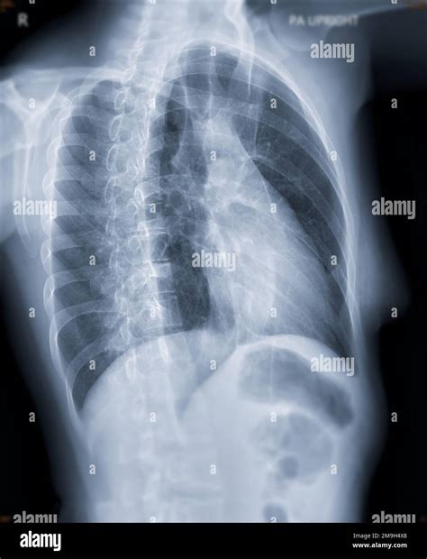 Chest X Ray Tb Expiration at Ann Burkett blog