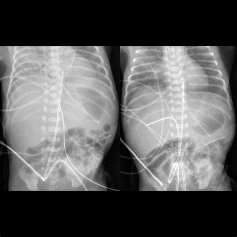 Umbilical Venous Catheter Malfunction / Malposition / Misposition ...
