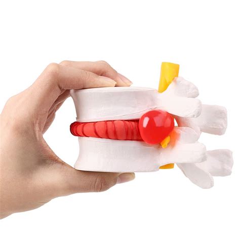 Winyousk Human Anatomical Lumbar Disc Herniation Model - India | Ubuy