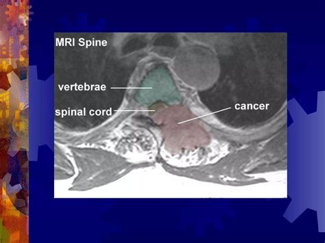 Spinal Cord Syndrome | PPT