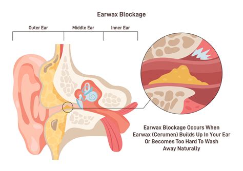 Cerumen Removal | Schedule Ear Wax Removal — Medical Hearing Associates
