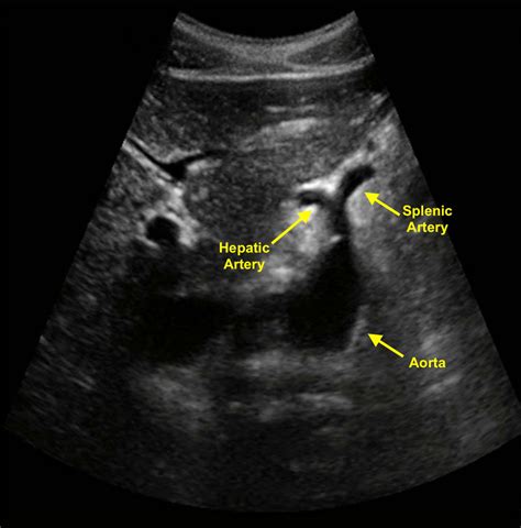 Splenic Artery Aneurysm Ultrasound