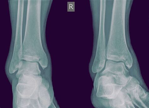 Medial Malleolus Fracture and Broken Ankle Treatment