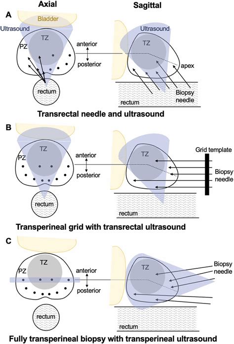 A Novel Magnetic Resonance Imaging/Ultrasound Fusion Prostate Biopsy ...