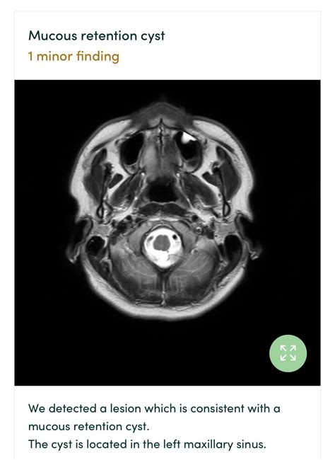 Mucous retention cyst, tinnitus : r/Sinusitis