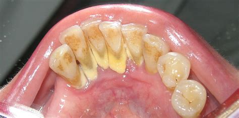 Image result for Bottom Teeth Calcium Buildup