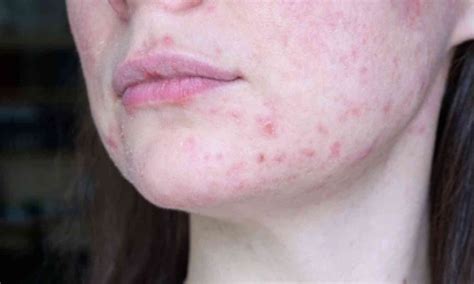 Heat waves in north India are causing a rise in Lupus cases: Doctors
