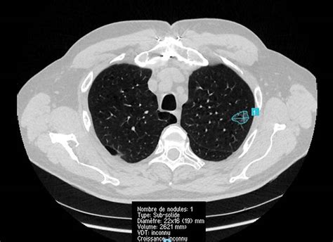 Image result for Poumon Normal Scanner