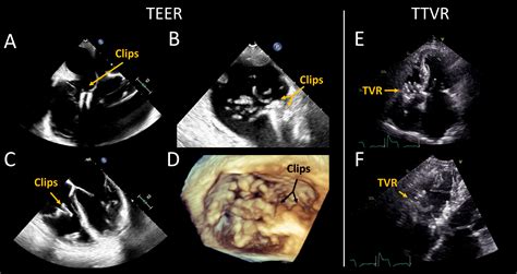 Transesophageal Echocardiogram 4 Chamber