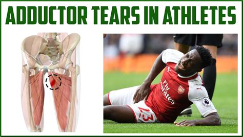 Adductor Tears in Athletes - Sports Medicine Review