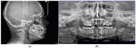 Advancing Orthodontic Aesthetics: Exploring the Potential of Injectable ...
