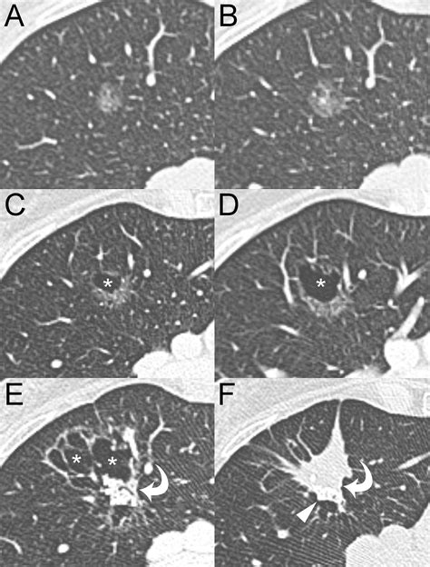 Hilly or mountainous surface: a new CT feature to predict the behavior of pure ground glass ...
