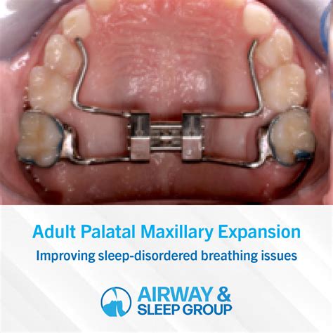 Top 103+ Pictures Palate Expander Before And After Photos Stunning