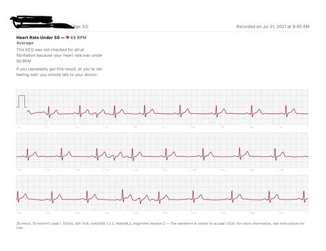 Abnormal ECG reading? : r/medical
