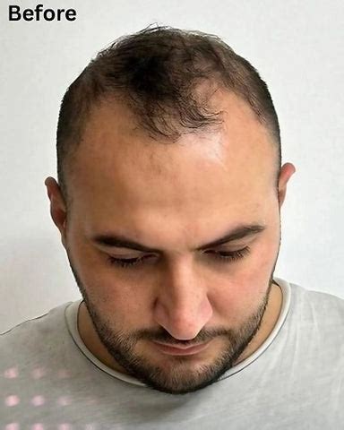 Incredible Grafts Hair Transplant Before and After: Hair Restoration ...