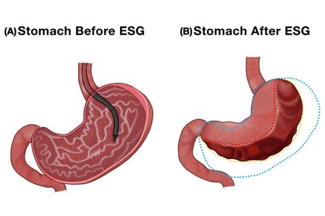 Endoscopic Sleeve Gastrectomy Cost at Dean Metoyer blog