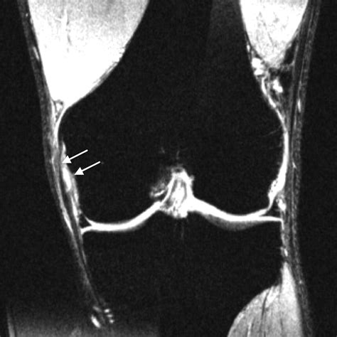 Medial Collateral Ligament Mri