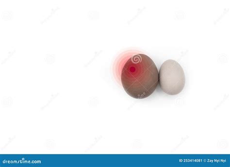 Concept of Right Sided Scrotal Swelling or Testicular Pain Stock Image - Image of eggs ...