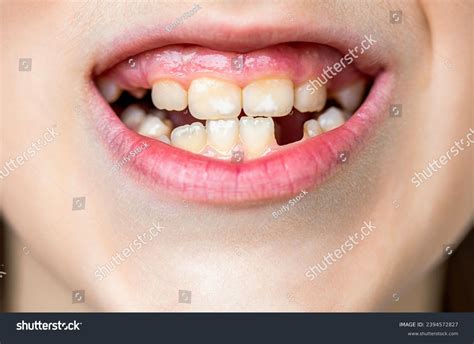 Image result for Discolored Tooth