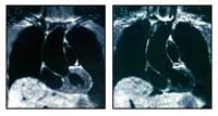 Cirugía para enfermedad de las arterias coronarias | Centro Médico Teknon