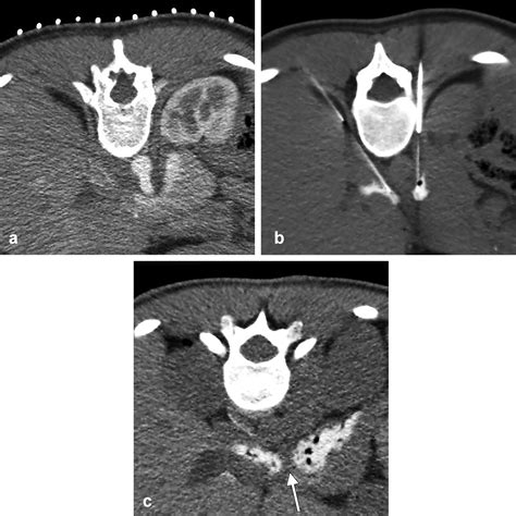 Clinical Response to Celiac Plexus Block Confirms the Neurogenic ...