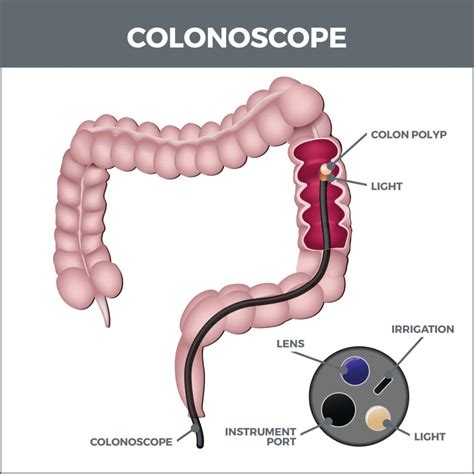 Getting a Colonoscopy 的图像结果
