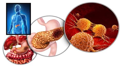 Pancreatic Cancer : ఈ లక్షణాలు ఉంటే ప్రాణాంత వ్యాధిగా భావించాల్సిందేనా ...