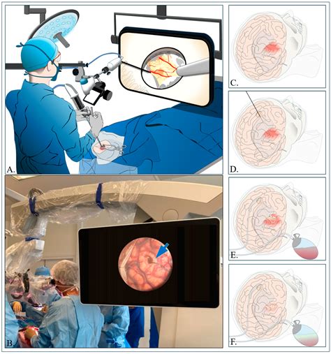 Minimally Invasive Surgery for Spontaneous Intracerebral Hemorrhage: A ...