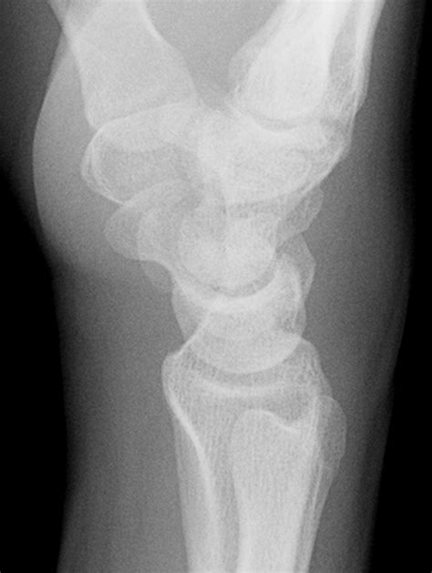 X Ray Wrist Lateral View