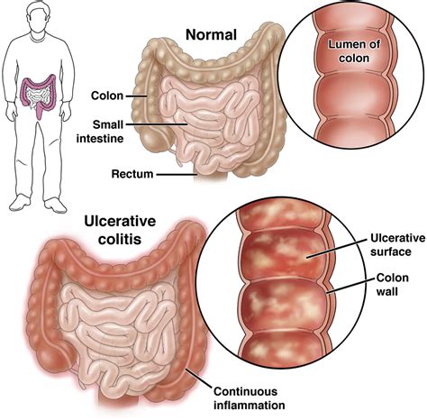 Image result for Colonoscopy Colitis