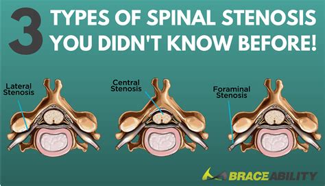 The Difference Between Foraminal, Central, & Lateral Recess Stenosis in Your Spinal Cord ...
