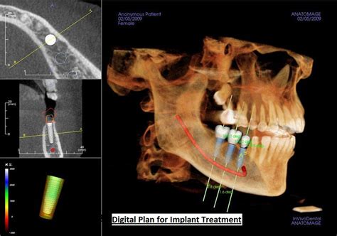 Burute Dental Clinic - Trusted Dental Implant Centre in PCMC