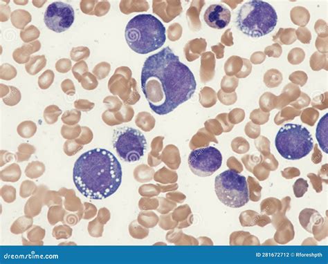Monoblastic Leukemia