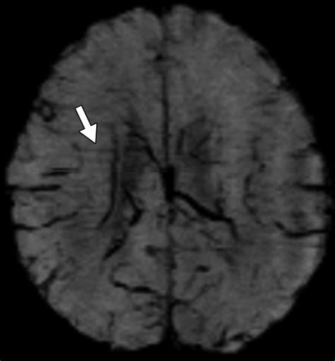 Susceptibility-Weighted Imaging of the Pediatric Brain | AJR