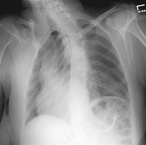 Image result for Poumon Normal Scanner