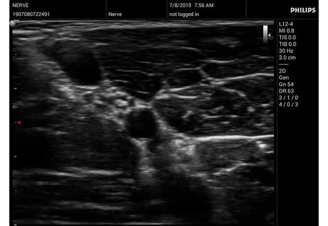 Philips - InnoSight compact ultrasound system