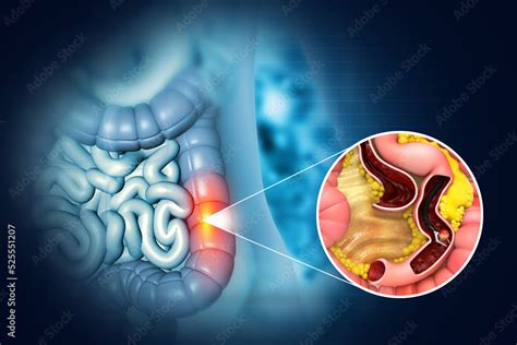 Image result for Colonoscopy Polyps