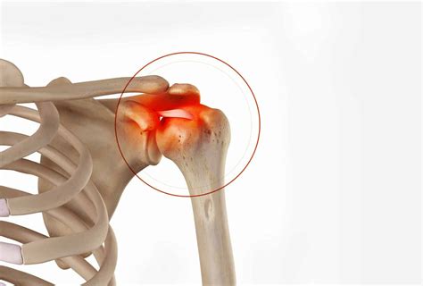 Calcific tendonitis, treatment and management | Doctor Philippe ...