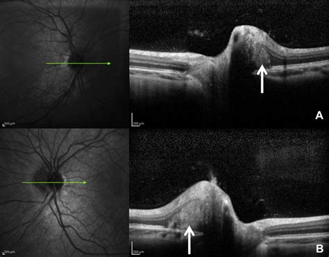 Differentiating Mild Papilledema and Buried Optic Nerve Head Drusen Using Spectral Domain ...