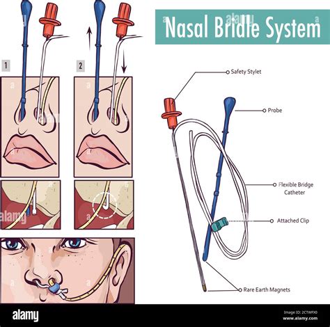 Nasogastric tube hi-res stock photography and images - Alamy