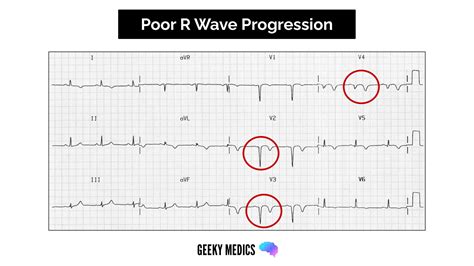 What Do Abnormal Ekg Look Like at Della Harding blog