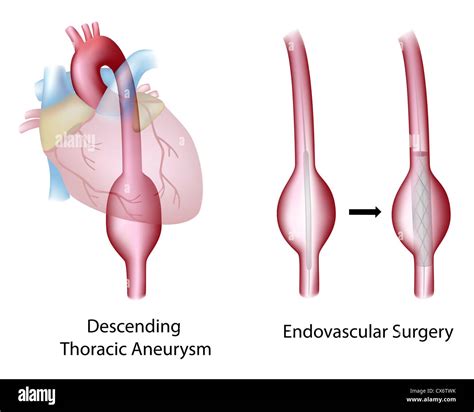 Thoracic (descending) aortic aneurysm and endovascular surgery Stock ...