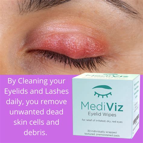 Eyelid Infection Cure