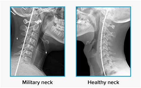 Cervical Spine Lordosis