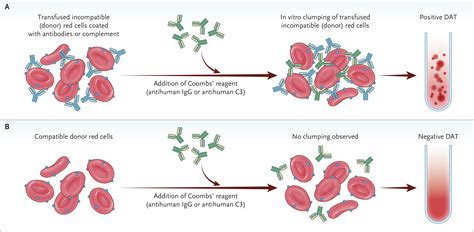 Hemolytic Transfusion Reactions | New England Journal of Medicine