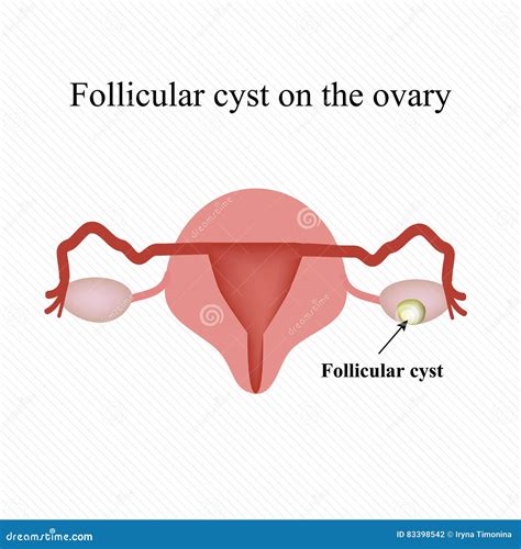 Radiopaedia Ovarian Cyst
