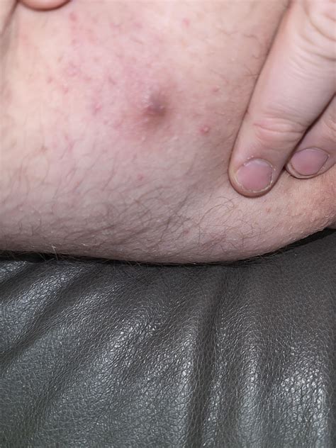 Dark lump on inner thigh closer to my rump. The bump is pretty big and goes under my skin ...