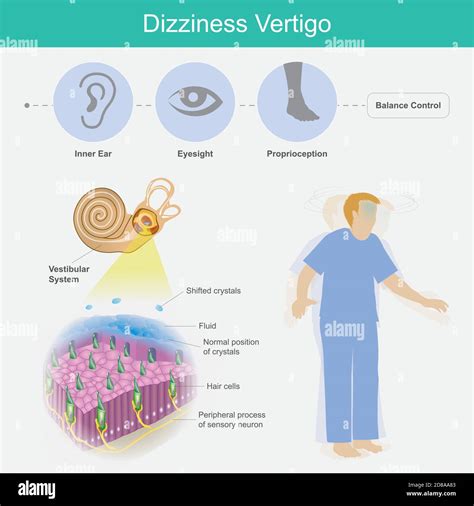 Crystals In Your Ear That Cause Vertigo at Ashley Smalley blog