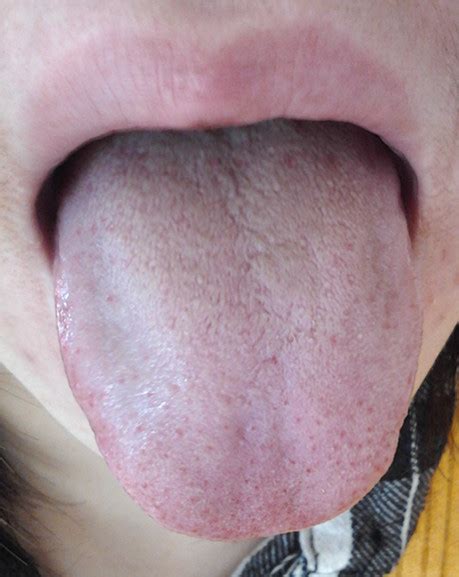 湿热体质的舌头是什么样的_百度知道